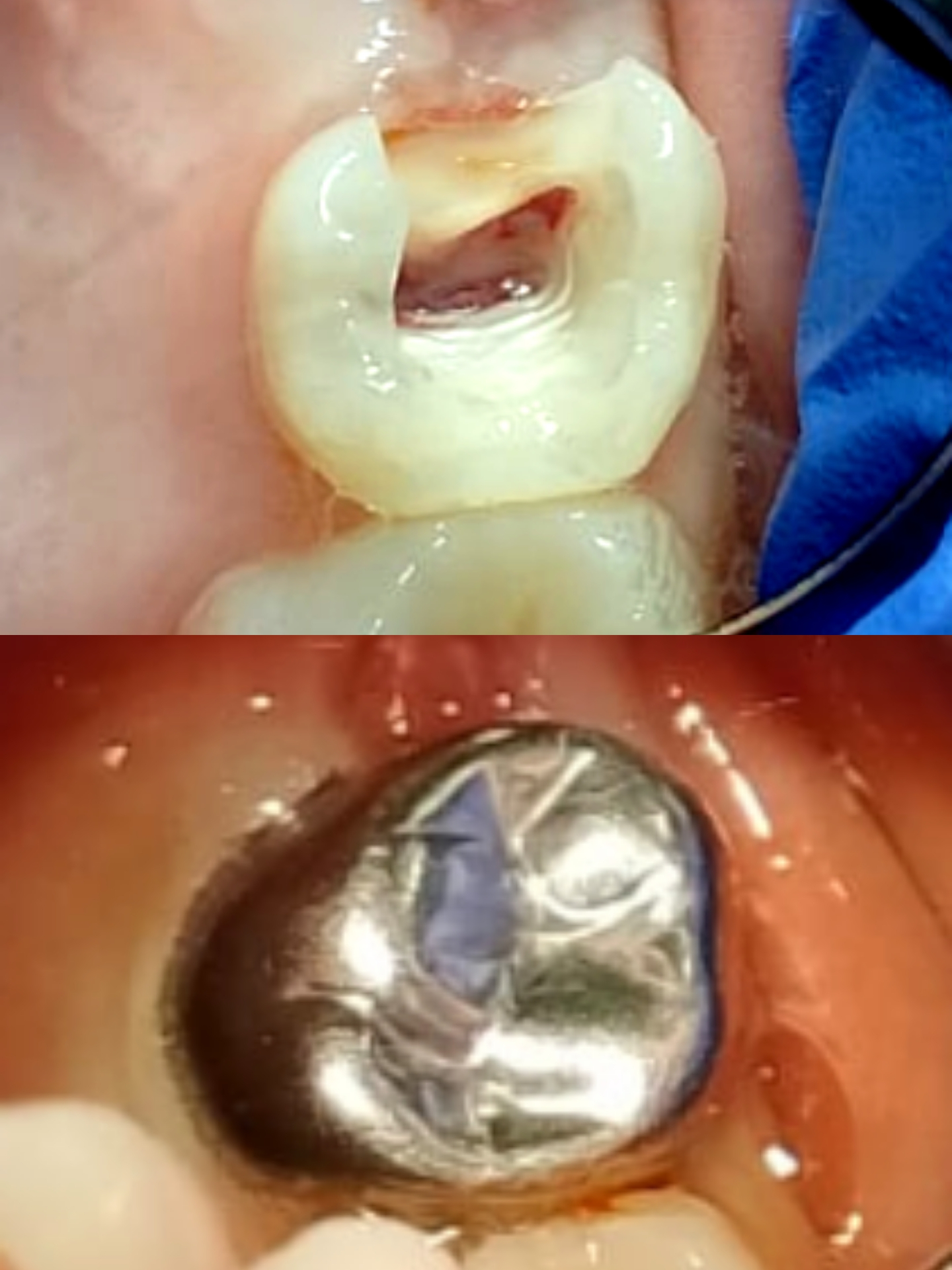 علاج أسنان الأطفال